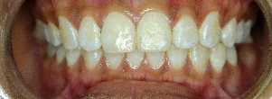 what is dental fluorosis?